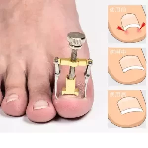 Details about New Pro Ingrown Toe Nail Recover Toenail Correction Pedicure Fixer